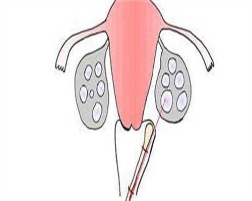 失独北京助孕，全委托包成功