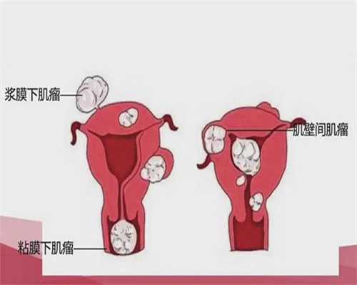 输卵管堵塞了可以疏通吗